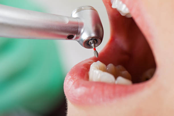 Best Emergency Root Canal Therapy in Breckenridge Hills, MO
